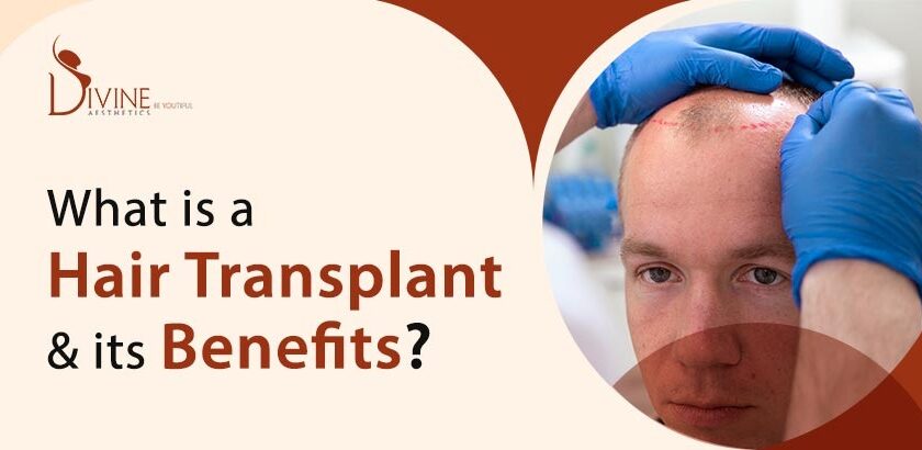 What is a Hair Transplant & its Benefits?